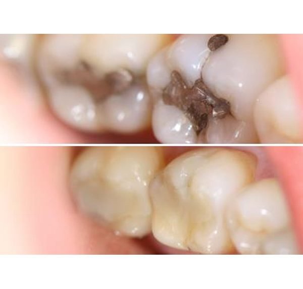 DISTILLED WATERS VS. MERCURY FILLINGS