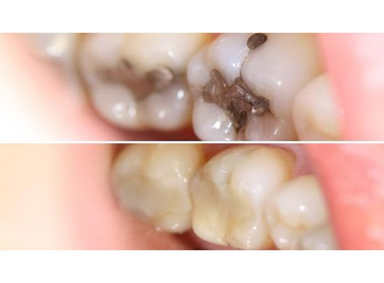 DISTILLED WATERS VS. MERCURY FILLINGS